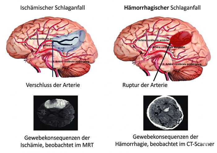 Intensive Post- Schlaganfall- Rehabilitation