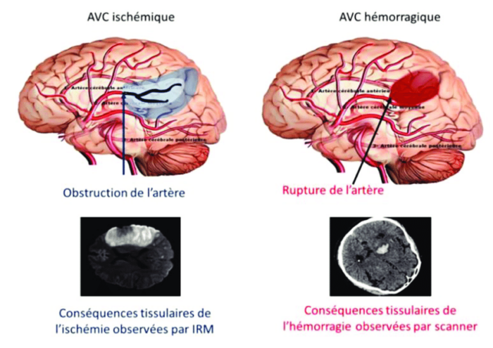 Illustration AVC ischémique et AVC hémorragique